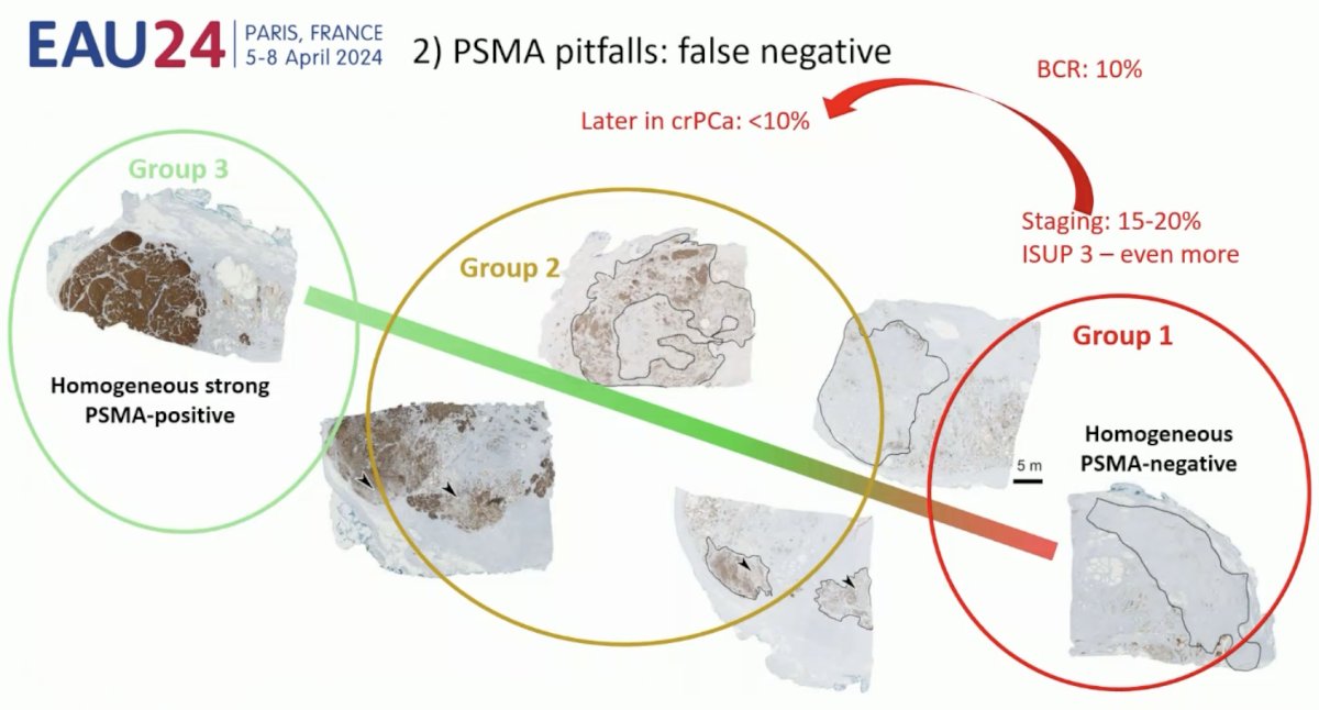  PSMA false-negative findings, particular in the intra-prostatic assessment of Grade Group