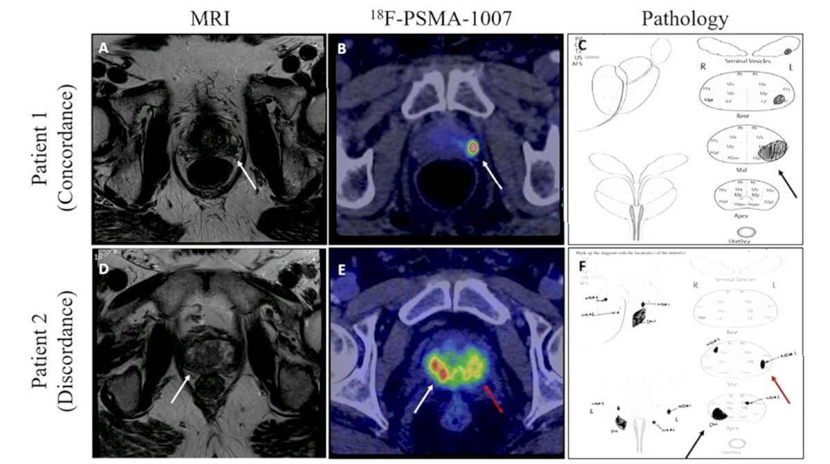 multiparametric MRI, 18F-PSMA-1007, and pathology concordance and discordance images