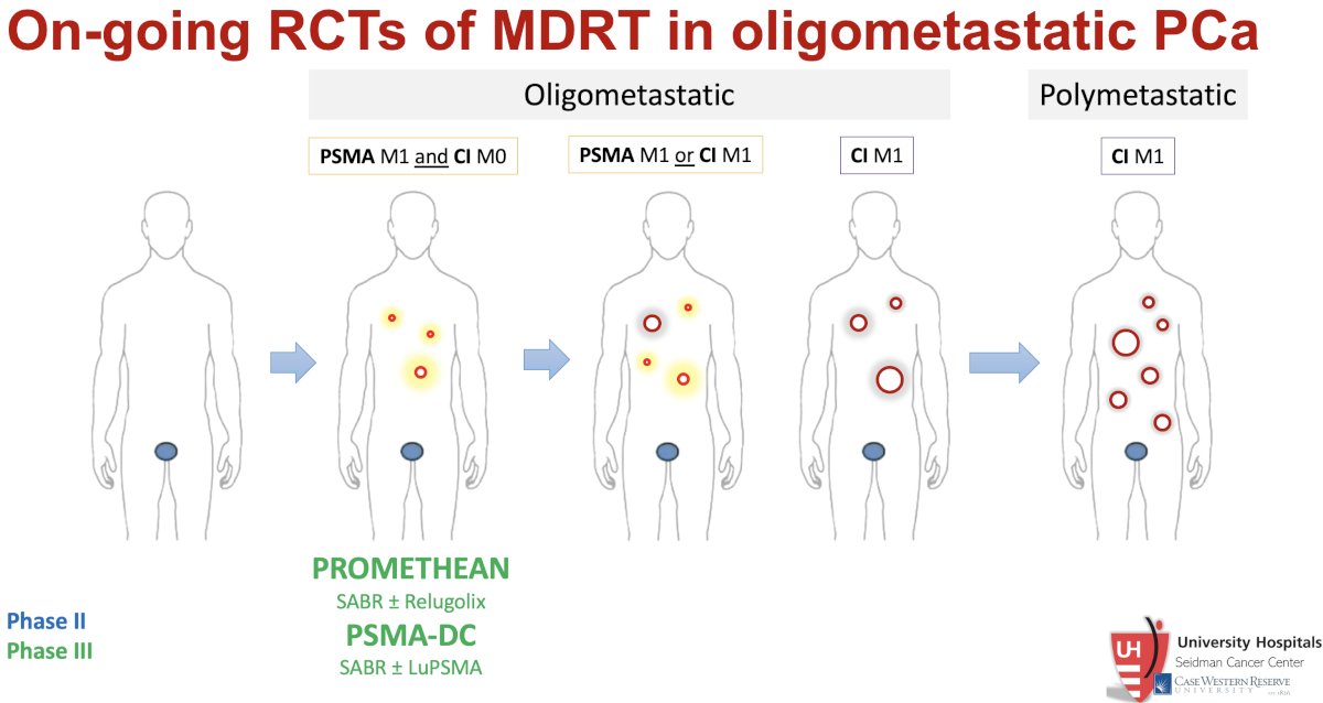 Ongoing randomized controlled trials of MDT with SABR in oligometastatic prostate cancer
