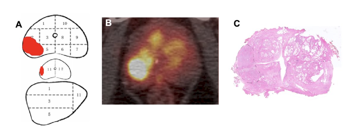  66 year old patient with biopsy positive regions in 2, 4, 5, and 11 (A). 68Ga-P16-093 PET/CT exhibited high PSMA uptake in the right peripheral zone of the prostate, with an SUVmax of 9.1 (B). Pathologic examination confirmed the presence of prostate cancer in the right peripheral zone, consistent with the 68Ga-P16-093 PET/CT findings (C)