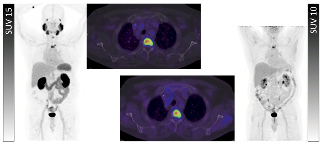 64 year old with metastatic castration resistant prostate cancer who was ineligible for radioligand therapy based on TheraP criteria (no lesion with PSMA SUVmax >= 20), but eligible according to 3TMPOA, 3TMPOB, and VISION