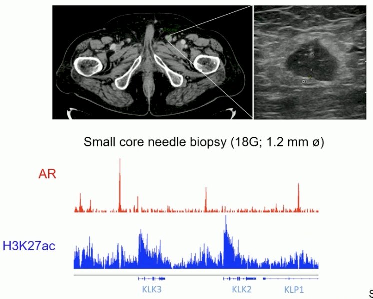 Dr. Zwart’s group was able to apply this technology to tissue obtained from an enlarged pelvic lymph node in a prostate cancer patient to determine which where androgen receptor and H3K27ac bind.