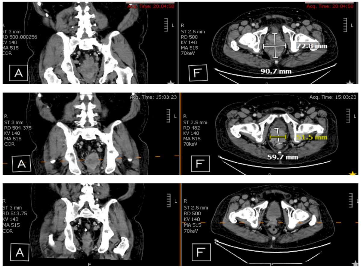 The second case was a 65 year old male who presented with de novo M1 prostate adenocarcinoma in January 2023 involving the nodes, bones, and lung