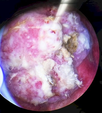 an example of an incomplete resection