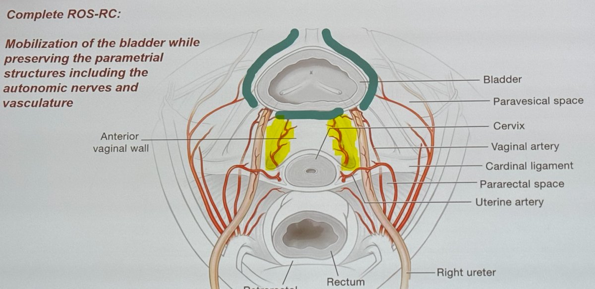 SUO 2024: Sexual Dysfunction and Radical Cystectomy