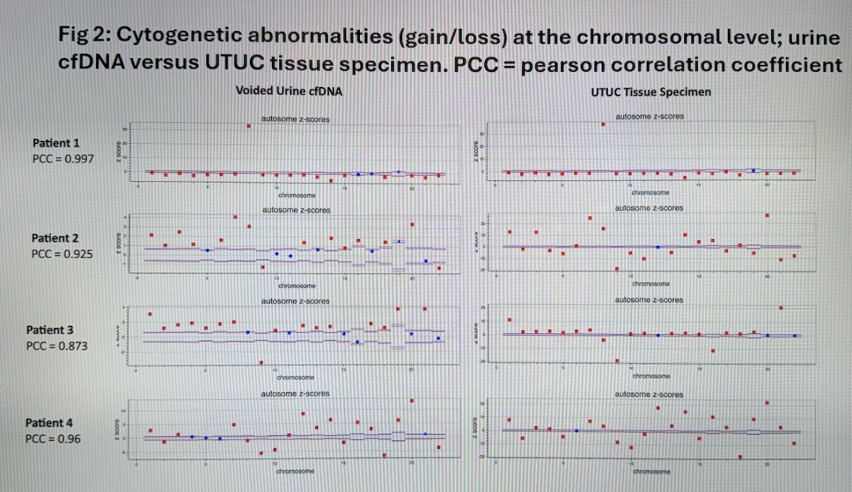 At the chromosomal level, we observed that CNAs in urine cfDNA closely mirrored that of tissue