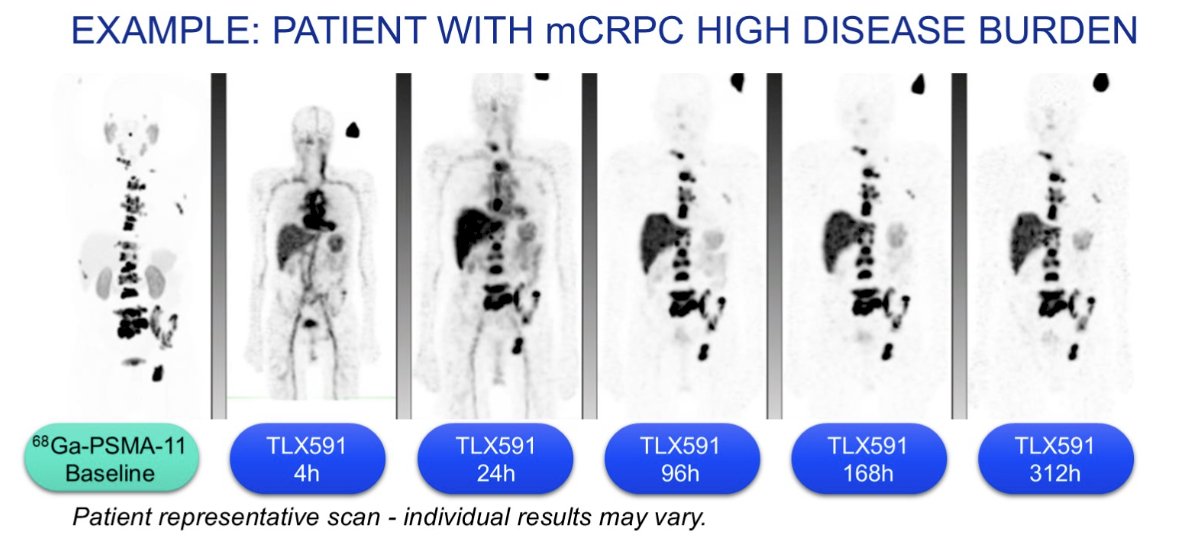 There is a strong rationale for further investigation of the 177Lu-labeled, chelator-conjugated antibody, 177Lu-rosopatamab, as a potential first-line radioimmunotherapy candidate for the treatment of prostate cancer. The ProstACT SELECT results showed uptake and retention in tumor and metastases up to 14 days after one dose of 177Lu-rosopatamab