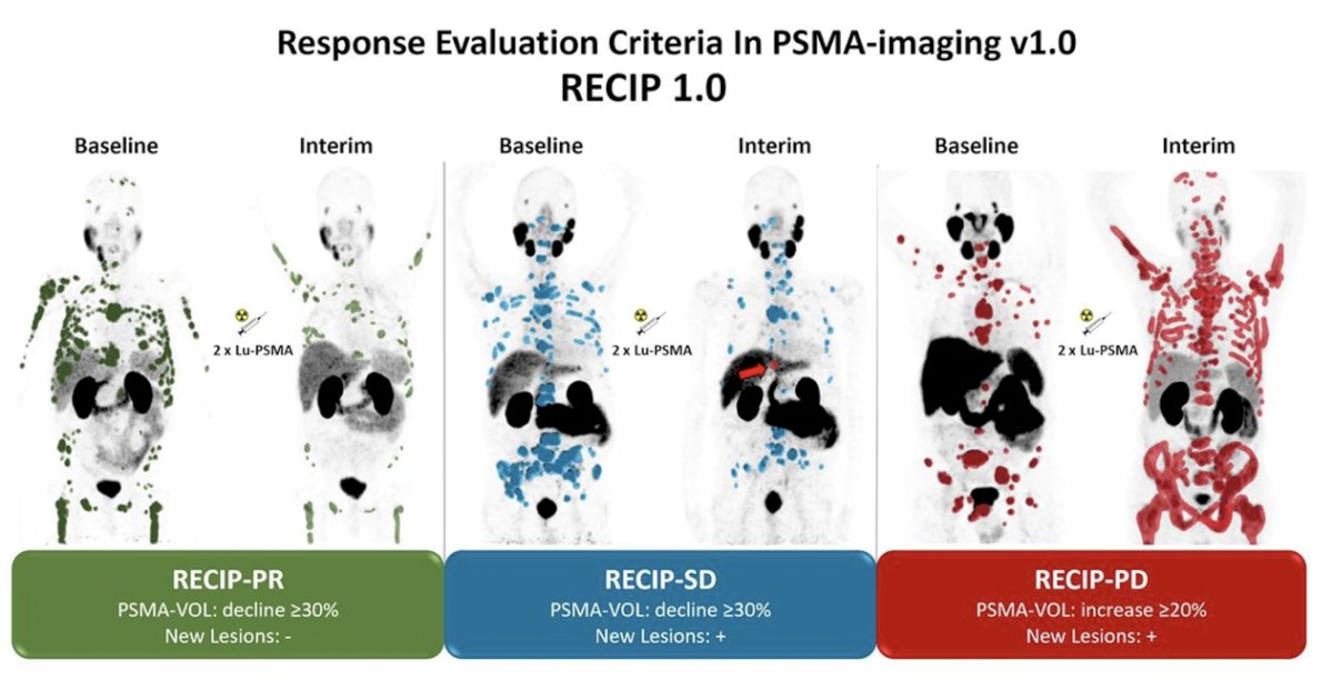 The following demonstrates utilization of RECIP 1.0 to delineate RECIP-PR (PSMA volume decline >=30% and no new lesions), RECIP-SD (PSMA volume decline >=30% and new lesions), and RECIP-PD (PSMA volume increase >=20% and new lesions):