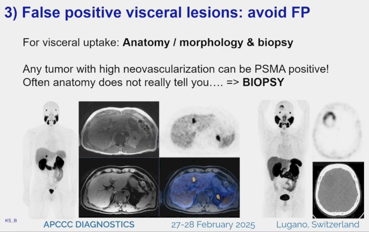 Dr. Burger noted that despite considering anatomy/morphology, it is often difficult to discern true positives from false positives. As such, biopsy is key in this setting.