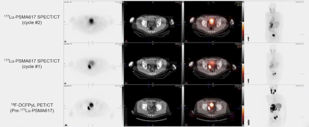 When and why should we stop 177Lu-PSMA-617 radioligand therapy? Dr. Iagaru notes that this should include when there is FDG positive/PSMA negative disease progression or when there is complete response to treatment