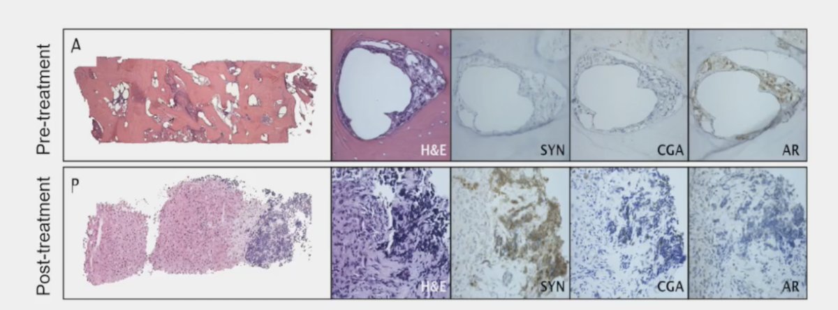 In prostate cancer, therapeutic pressure may lead to small cell/neuroendocrine prostate cancer transformation, and although rare, it is important to recognize. The following patient developed new liver and lung metastases while on abiraterone in the absence of significant PSA progression (PSA 29 ng/mL)