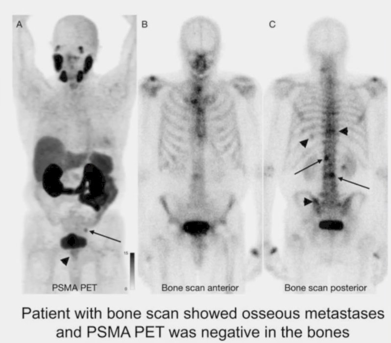 In patients at initial staging, the PPV, NPV, and specificity for bone scans were 0.43 (95% CI, 0.26-0.63), 0.94 (95% CI, 0.85-0.98), and 0.80 (95% CI, 0.68-0.88), respectively, suggesting that the PPV of bone scans was low in patients at initial staging, with 57% of positive bone scans being falsely positive:5