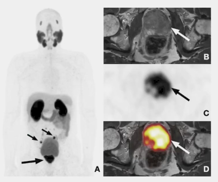 PSMA is the first radiotracer with an indication for the initial staging of prostate cancer.