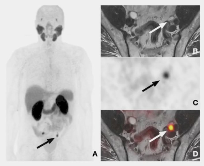 3. PSMA PET is able to detect lymph node metastasis.