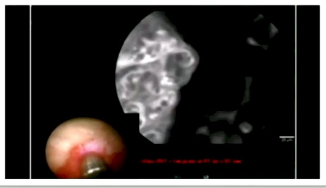 laser endomicroscopy.jpg