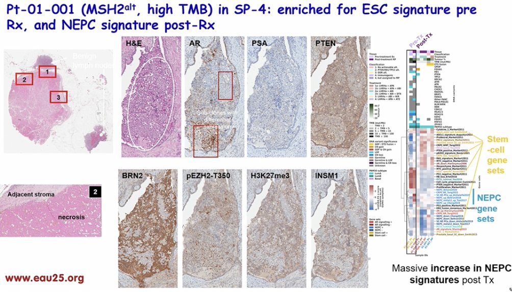 He discussed the case of patient 01-001 in GUNS, which exhibited an MSH2 alteration and high tumor mutational burden (TMB) in SP-4 after treatment. Notably, they also observed a significant increase in neuroendocrine prostate cancer signatures post-treatment, suggesting a potential shift in tumor biology.