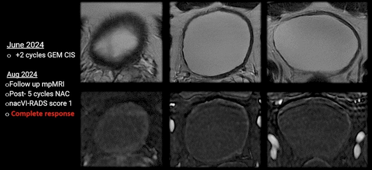He proceeded to receive two additional cycles of gem/cis in June 2024. In August 2024 and following completion of 5 cycles total of gem/cis, his MRI demonstrated nacVI-RADS score 1, and he had a complete response on repeat TURBT.