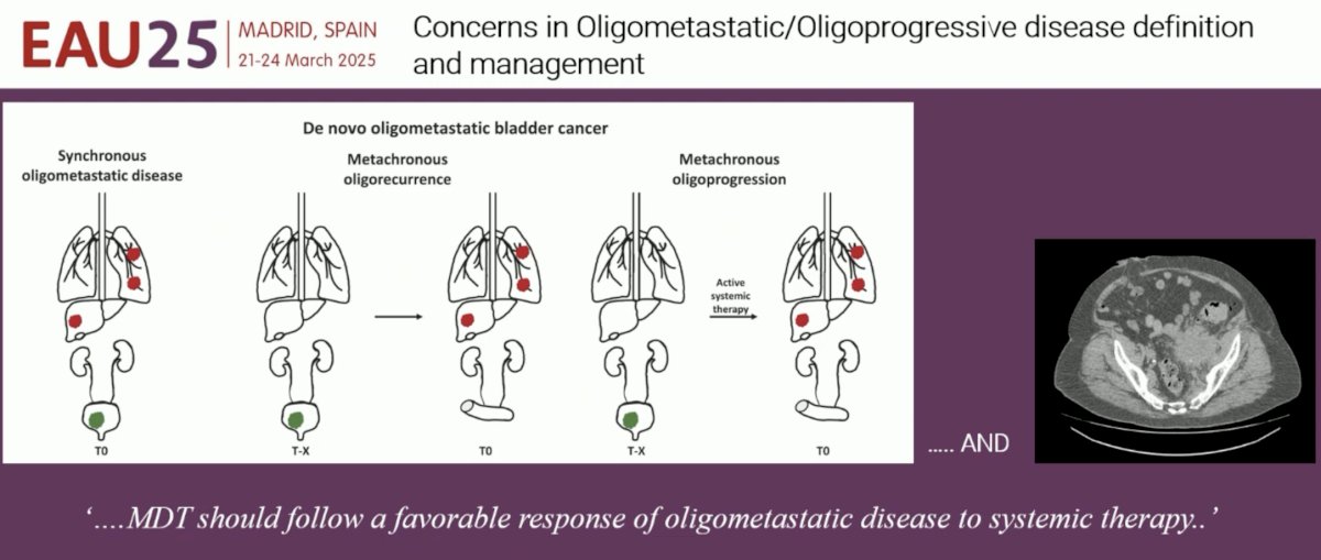 While some may argue that this patient has oligometastatic urothelial carcinoma, and thus should receive metastasis-directed therapy alone, Dr. Necchi argued that we cannot draw exact parallels from the oligometastatic prostate cancer paradigm, given that these patients have a more aggressive underlying biology with worse prognoses. Irrespective of whether these patients present with de novo or recurrent oligometastases following radical cystectomy, they should receive 1st line systemic therapy for metastatic disease, with metastasis-directed therapy reserved for patients who demonstrate a favorable response to systemic therapy.
