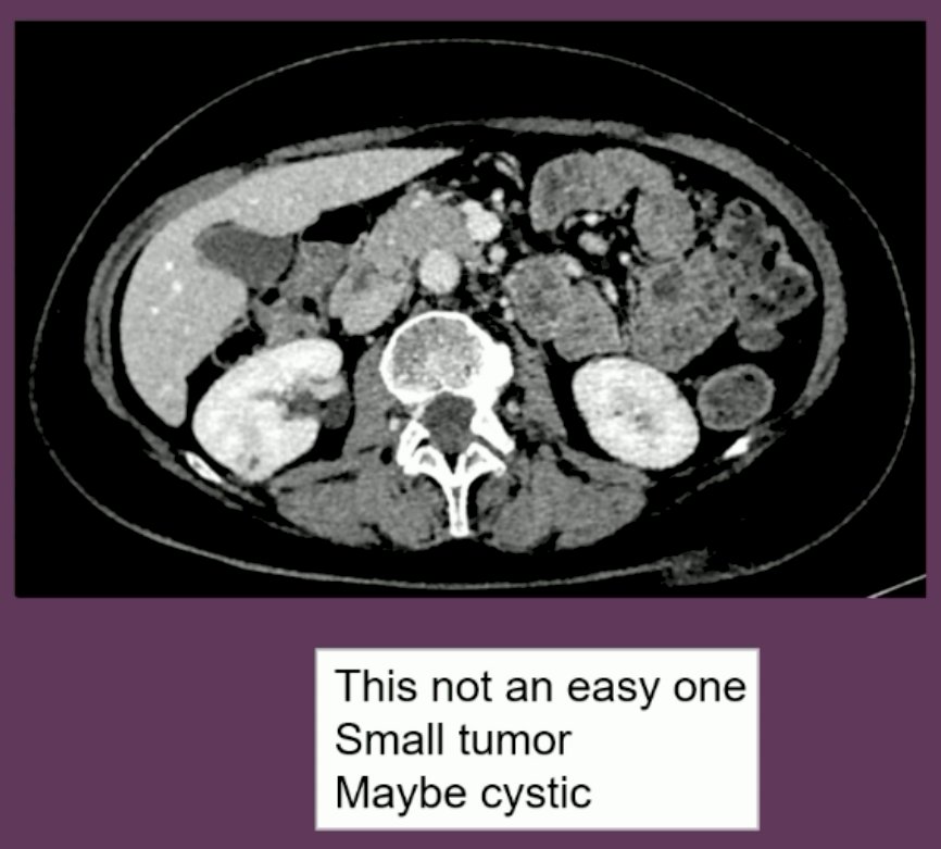 The patient in the case presentation has a small, possibly cystic tumor, which Dr. Bensalah argued is likely to yield a non-diagnostic RMB.