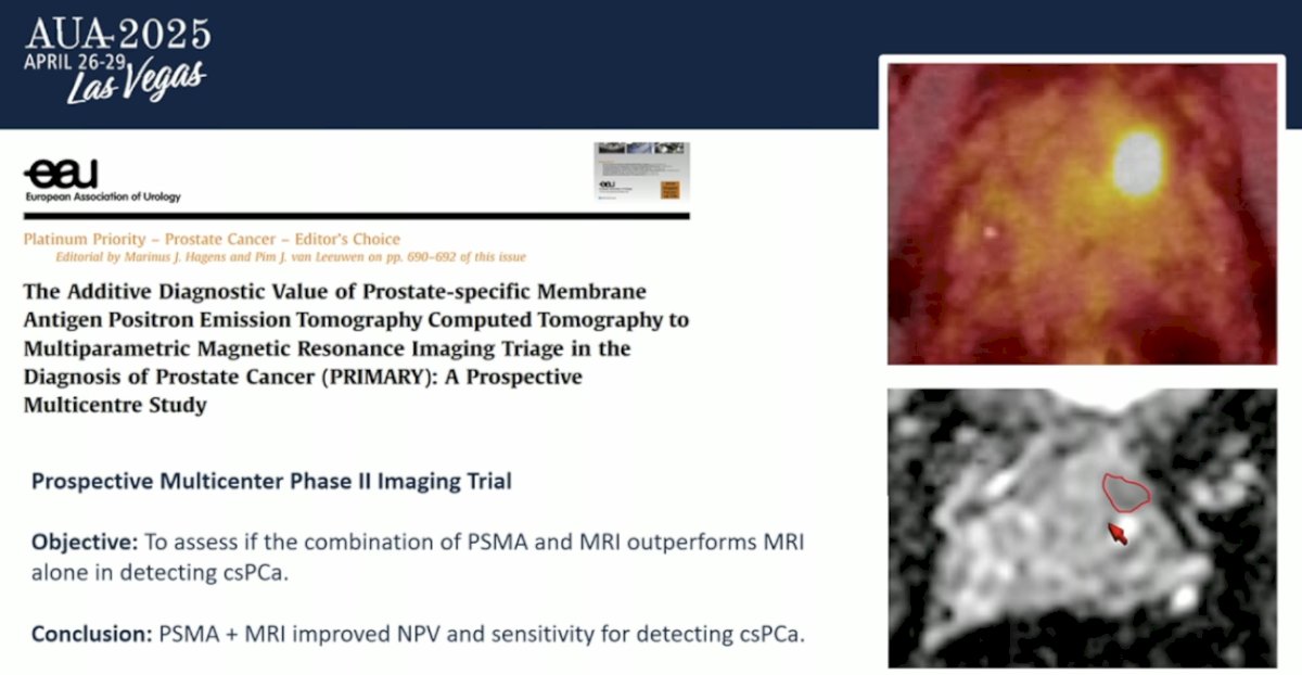 The field is moving forward with the introduction of PSMA PET imaging. Thanks to the PRIMARY prospective study, a multicenter Phase II imaging trial—the combination of PSMA PET and MRI was shown to outperform MRI alone in detecting clinically significant prostate cancer (csPCa). The study concluded that PSMA PET plus MRI improved both the negative predictive value and sensitivity for detecting csPCa. Beyond local staging, PSMA PET also allows us to identify patients with metastatic disease outside the pelvis.6