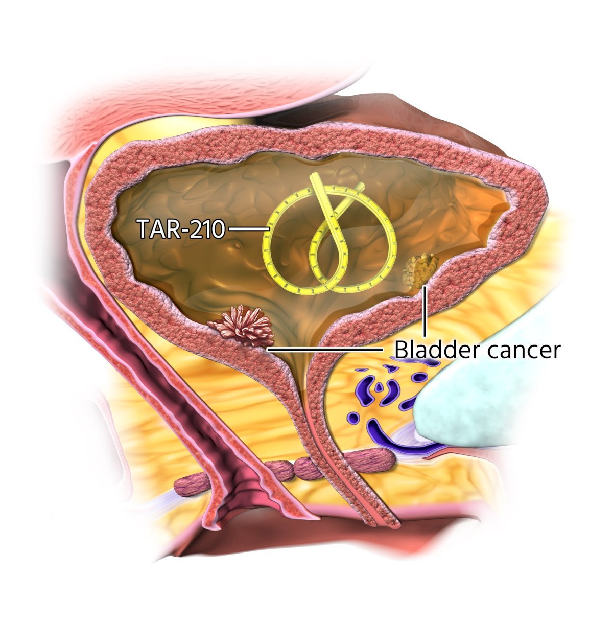 TAR-210 is a novel intravesical erdafitinib-releasing system designed for sustained local delivery of therapy over 3 months in the bladder and is inserted using a urinary placement catheter in a brief in-office procedure.
