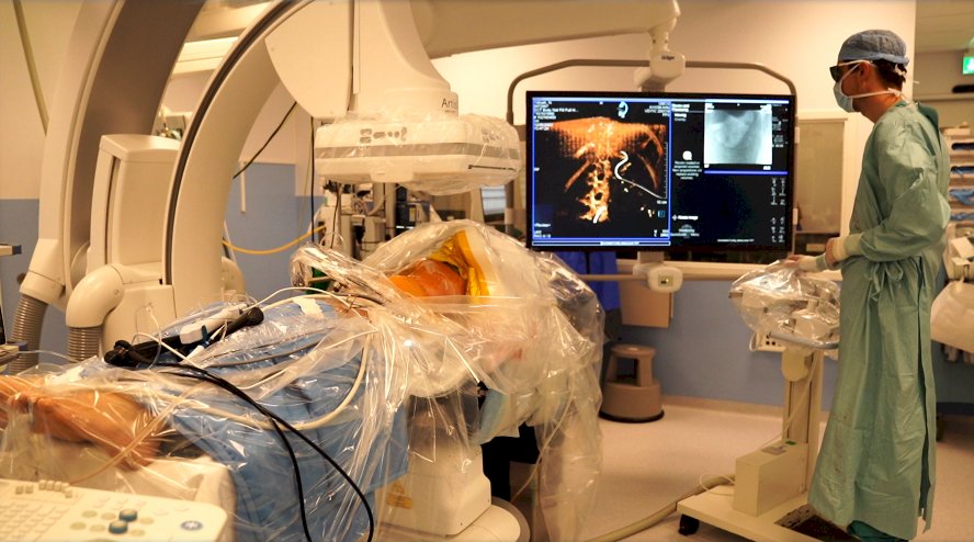  Unlike conventional CT, which requires a full 360-degree rotation and is impractical for surgery, CBCT utilizes a C-arm design with 200–250 degrees of coverage, making it feasible for real-time intraoperative imaging (Figure 1). As such, Dr. Kingma and his team investigated the impact of the detection of residual fragments via utilization of intraoperative CBCT to enhance stone-free rates and reduce long-term stone-related events.