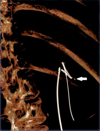 ts were assigned either to receive an intraoperative CBCT scan while the control group proceed without additional imaging. The CBCT scan was completed in an estimated 6 seconds. Individuals in the CBCT arm had any newly detected residual fragments addressed immediately during the same procedure and removed (Figure 2). NCCT imaging was completed postoperatively at 4 weeks and 1 year. Stone-free status (SFR) is defined by the absence of fragments larger than 4 mm. Additional follow-up over one year captured stone-related events, including reinterventions, symptom recurrence, hospitalizations, and emergency room visits. 