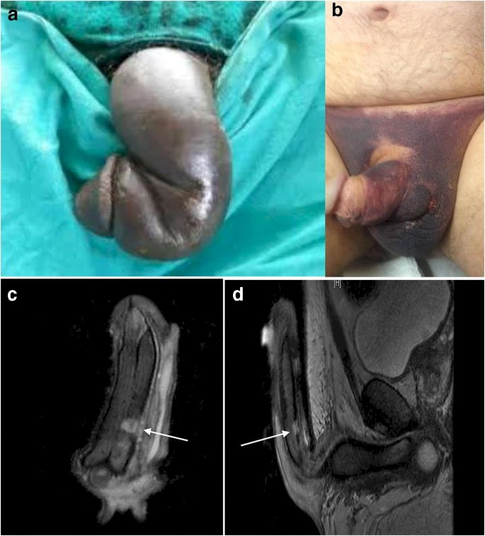 Dr. Mills goes on to explain the crucial differences between traumatic versus CCH-associated fractures, and identifying and treating them. Traumatic penile fractures result from blunt force trauma, and immediate surgical repair improves erectile function and long-term outcomes compared to observation. CCH-associated fractures can occur at the site of injection or, at the weakest point of tunica at the ventrolateral aspect, and not necessarily at the site of injection. This is thought to result from applied force and ongoing transmural degradation of the tunica. Most cases occur spontaneously during erection or interrcouse.