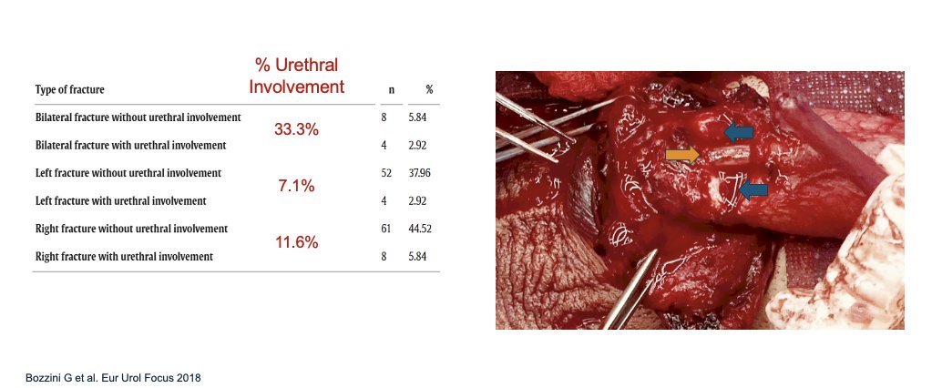 Moreover, Dr. Monn shares that one of the greatest risk factors for a urethral injury is bilateral fracture, which you can see in this image. In a European multi-institutional study, 33% of patients with a bilateral fracture had urethral involvement compared with less than 12% of the unilateral patients. Of note, this study was not included in the prior systematic review and had a much higher rate of urethral involvement at around 11.6%.