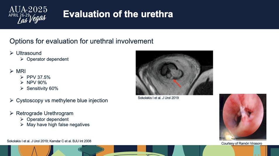 Moreover, Dr. Monn shares that one of the greatest risk factors for a urethral injury is bilateral fracture, which you can see in this image. In a European multi-institutional study, 33% of patients with a bilateral fracture had urethral involvement compared with less than 12% of the unilateral patients. Of note, this study was not included in the prior systematic review and had a much higher rate of urethral involvement at around 11.6%. 2
