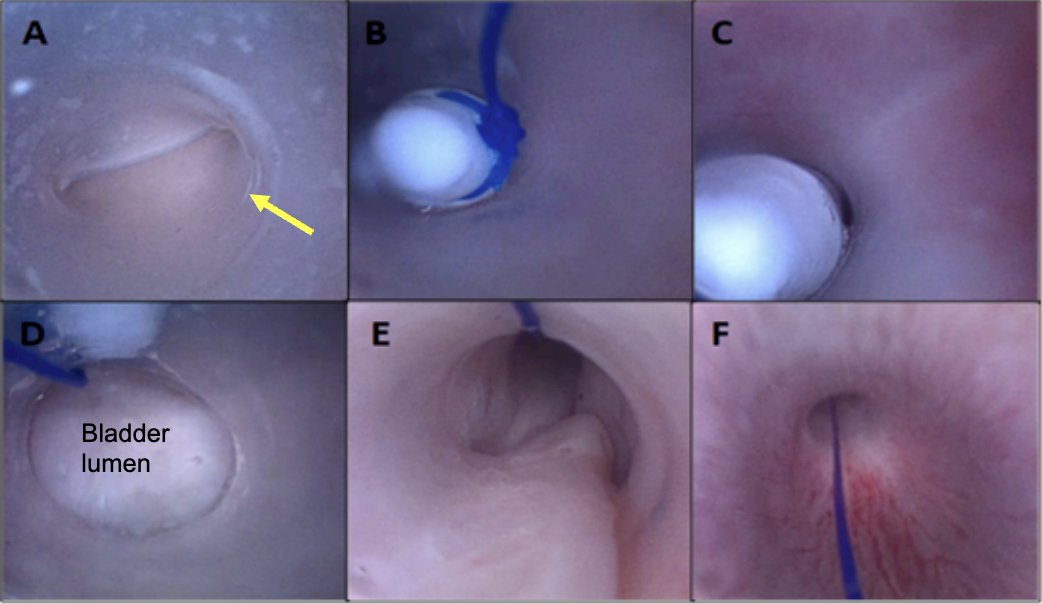 Figure 2 (below). A) A 21F silicone tube indicated by the yellow arrow is placed in the bladder. B-C) UM is pushed through the silicone tube by the cystoscope. D) The UM is deployed in the bladder. E-F) Cystoscopy confirms an atraumatic urethra after UM deployment.