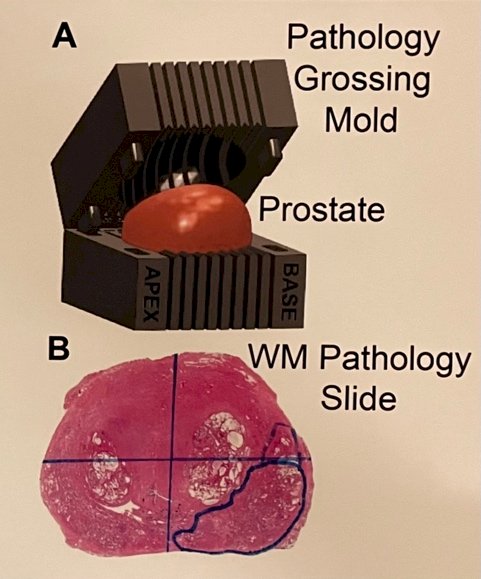 In this IRB-approved pilot study, ten men scheduled for radical prostatectomy were enrolled. After surgery, their prostates were sectioned, stained, and analyzed with a custom MATLAB computer vision algorithm (Figure 2).