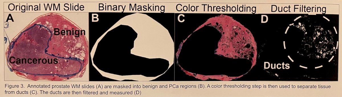 The study evaluated 54 whole-mount pathology slides, which were scanned and annotated to distinguish benign tissue from cancerous lesions. A binary masking and color thresholding pipeline was used to quantify key features of the ducts, specifically the duct equivalent diameter and the ductal ratio (the proportion of white space representing ducts within the tissue) (Figure 3).