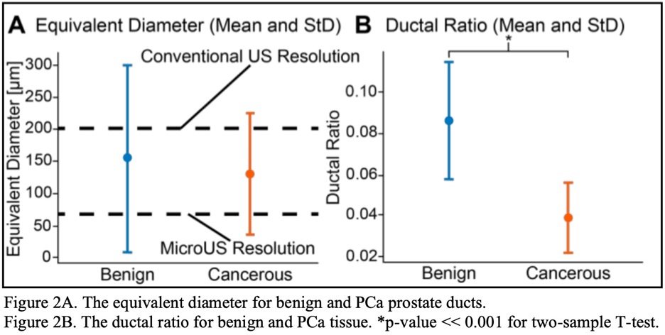 The team identified a total of 145,150 benign ducts and 9,245 cancerous ducts. Results showed that benign ducts had a significantly larger mean diameter (155.7 ± 147.8 µm) compared to cancerous ducts (129.4 ± 94.3 µm). To this end, while the mean diameter for both tissue types remain below the conventional ultrasound resolution threshold (200 µm), the MicroUS resolution threshold is lower than the mean diameters, therefore being easily detected with the later method (Figure 4A). Additionally, the ductal ratio was more than halved in PCa tissue (0.039 ± 0.017) compared to benign areas (0.086 ± 0.029), with both findings achieving high statistical significance (p << 0.001) (Figure 4B).