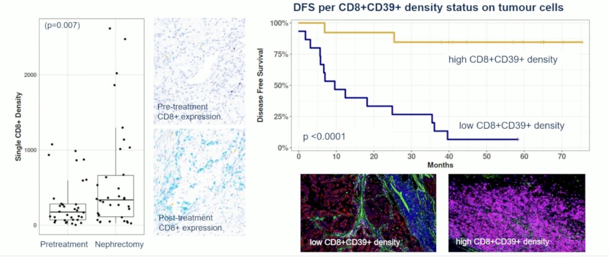 On multiplex immunohistochemistry, an influx of CD8+CD39+ tumor-reactive T-cells among post-treatment tumor cells was shown to be associated with prolonged DFS.