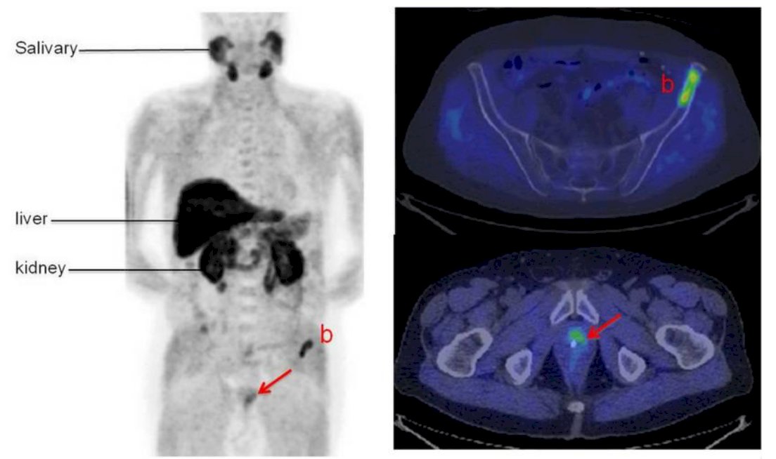 PSMA PET/CT Scan PSMA has physiologic tracer uptake in the salivary glands, liver, and kidneys. Despite this, PSMA PET/CT offers excellent sensitivity for detecting prostate cancer recurrence, as shown by the clear visualization of pelvic lymph node metastasis and local recurrence in the images below. The high tumor-to-background contrast makes PSMA PET/CT a valuable tool for precise localization of disease, even at low PSA levels. Moreover 18F labelled PSMA could be use as radioligand therapy.