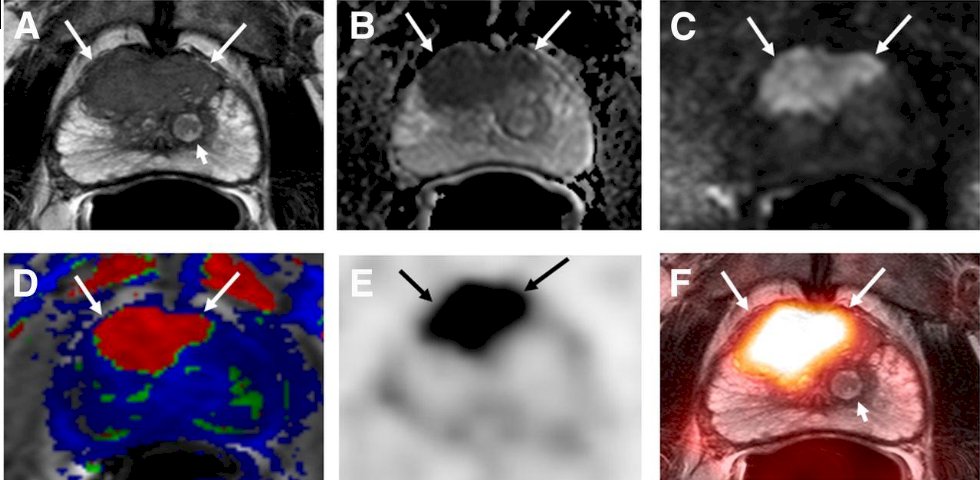 Dr. Gamie also addressed the potential role of hybrid PSMA PET/MRI in initial prostate cancer staging. By combining the functional sensitivity of PSMA PET with the superior anatomical resolution of MRI, this modality may enhance lesion detection, improve local staging, and inform lesion-targeted approaches.