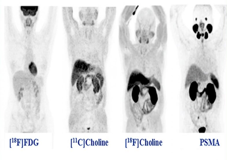 Various radiotracers can be used for prostate cancer imaging, with PSMA-based tracers demonstrating superior lesion detection compared to [¹⁸F]FDG and choline-based agents [¹⁸F]Choline and [11C] Choline.