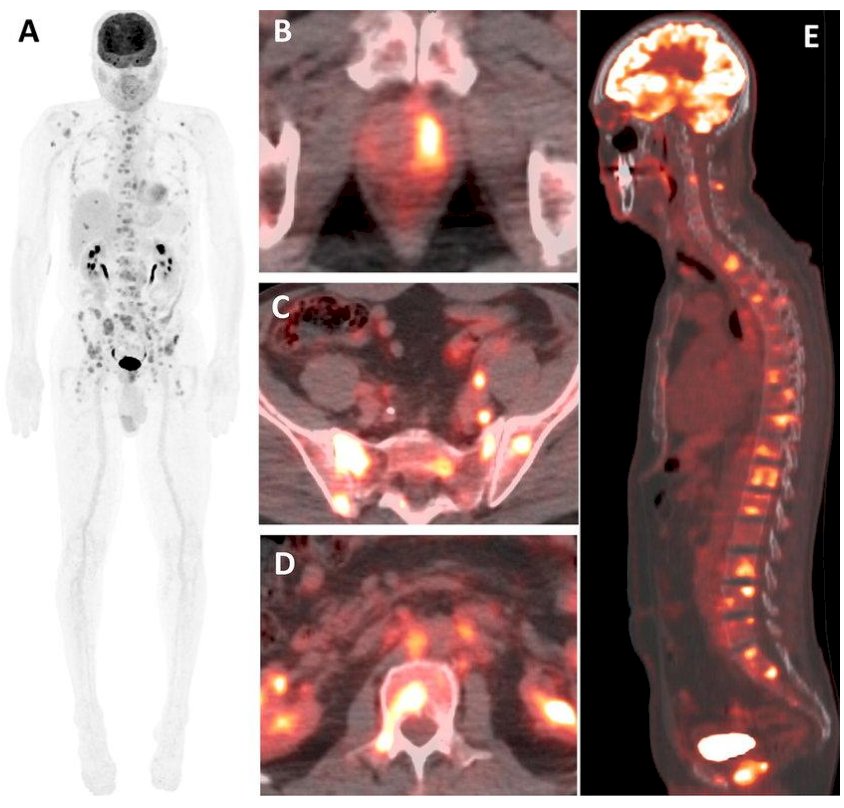 FDG PET/CT Scan FDG PET/CT has limited sensitivity in prostate cancer due to typically low glucose metabolism in most tumors, but it can be useful in advanced or aggressive cases particularly in neuroendocrine or dedifferentiated disease where higher FDG uptake is observed.