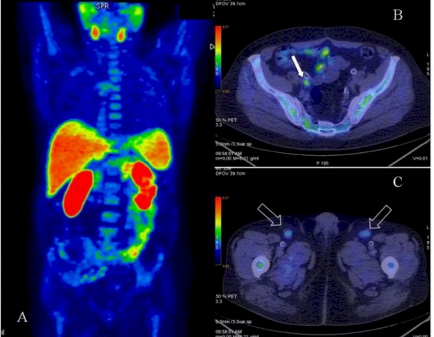 PET/CT was one of the earlier PET tracers used for prostate cancer imaging, particularly useful in detecting biochemical recurrence. It leverages increased cell membrane turnover and choline kinase activity in tumor cells. However, its limitations include relatively low sensitivity for low PSA disease, physiological uptake in benign prostatic hyperplasia and the liver, and a short half-life requiring an on-site cyclotron.