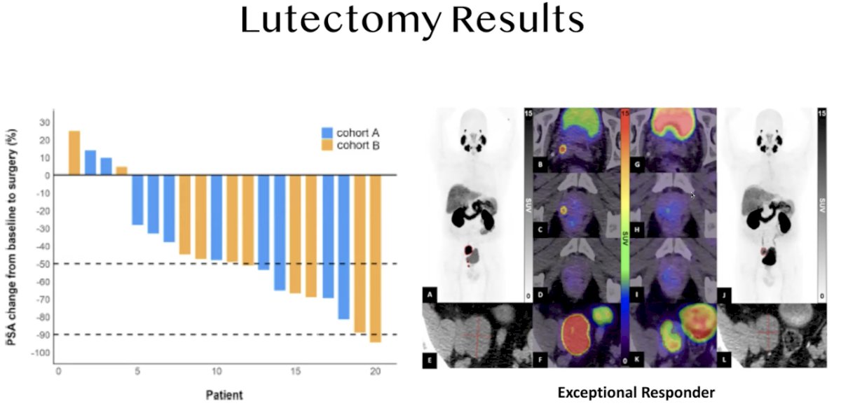 Although these are still early findings from the first trial of its kind in this neoadjuvant setting, they underscore the feasibility and potential of theranostic approaches for high-risk localized prostate cancer. Based on these encouraging results, a follow-up trial is now being planned at UCLA to further investigate the efficacy and role of LuPSMA in this context.