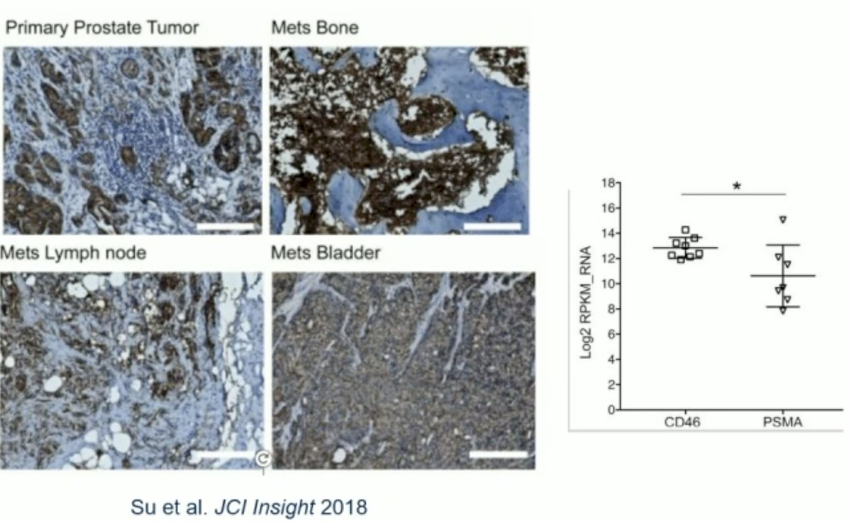 CD46 is a cell surface membrane cofactor protein that is highly expressed in prostate cancer cells, with a particularly high expression in de-differentiated tumors and those with lineage plasticity (e.g., t-SCNC). There is a high expression of CD46 in PSMA-negative tumors,1 which makes CD46 an alternative and complimentary target for PSMA. An anti-CD46 targeted antibody, YS5, was recently developed by Dr. Bin Liu at UCSF.&nbsp;