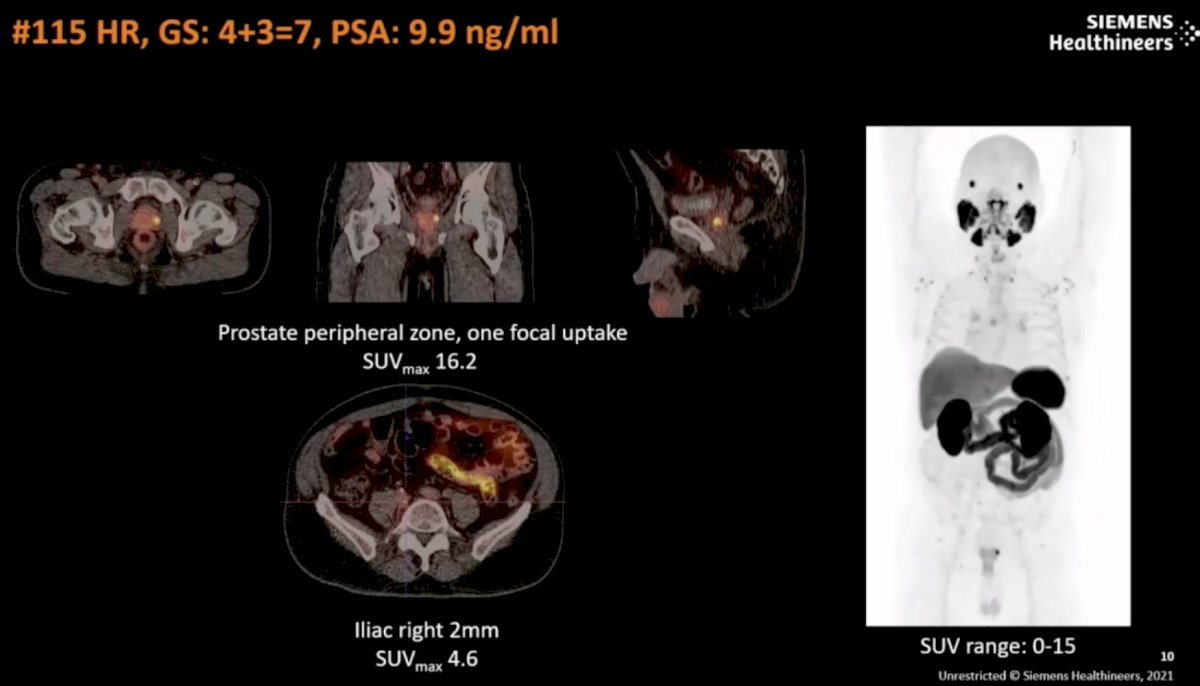 The phase I/II results demonstrated: Favorable visual tumor/background contrast ratio (average 18.55/1.19) All 18F-SMS-5368 positive lesions correlated with histopathological findings post-radical prostatectomy There was 100% concordance between local and central radiological interpretations No investigational drug-related adverse or serious adverse events were reported