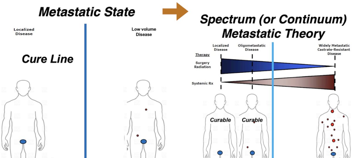 The treatment paradigm for metastatic prostate cancer is shifting from a binary concept, localized versus metastatic, toward a spectrum or continuum model. Traditionally, crossing the “cure line” into metastatic disease implied incurability, with therapy aimed primarily at palliation. In the spectrum-based approach, low-volume or oligometastatic disease is viewed as a potentially curable state, where aggressive local and metastasis-directed therapies, such as surgery or radiation, may meaningfully alter the disease course.&nbsp;