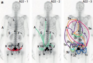 He highlighted the concept that metastatic cells may return to the primary tumor or “self-seed.” Both the primary tumor and established metastases can generate new metastatic deposits. According to the “clone theory,” altering the natural history of oligometastatic disease may require treating both the primary lesion and all detectable metastases, aiming to disrupt the cycle of seeding and reseeding that drives progression as shown below.&nbsp;