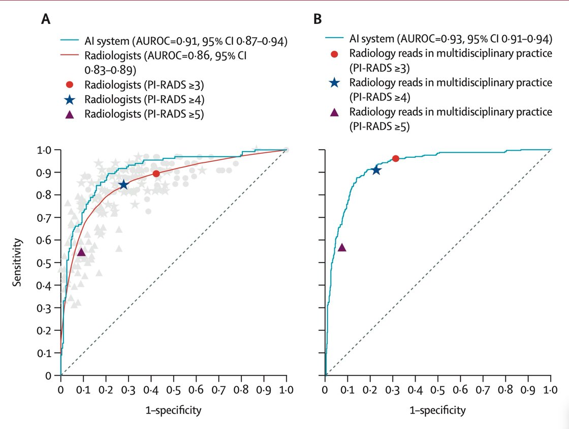 Notably, in the PI-CAI study, pooled radiologists achieved an AUC of 0.86 with a PPV of 53% and NPV of 90%, whereas the AI system outperformed them with an AUC of 0.91, PPV of 68%, and NPV of 94%. Importantly, AI detected nine additional clinically significant cancers, reduced 57 false positives, and avoided eight GG1 overdiagnoses, underscoring its potential to enhance diagnostic accuracy and reduce unnecessary interventions compared to standard PI-RADS assessments as illustrated below.2