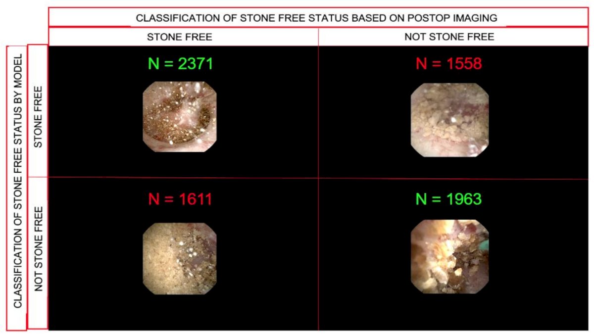 Figure 3. Confusion matrix comparing stone-free status classification between postop CT imaging and the transformer model.&nbsp;