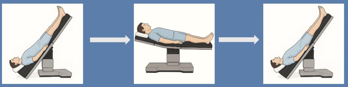 A Trendelenburg break was undertaken at the discretion of the anesthesia team around the 4 hour mark during a non-critical portion of the procedure. The patient was leveled to zero-degree tilt in the supine position for 15 minutes, then placed in steep Trendelenburg once again, and the case continued in a standard fashion: