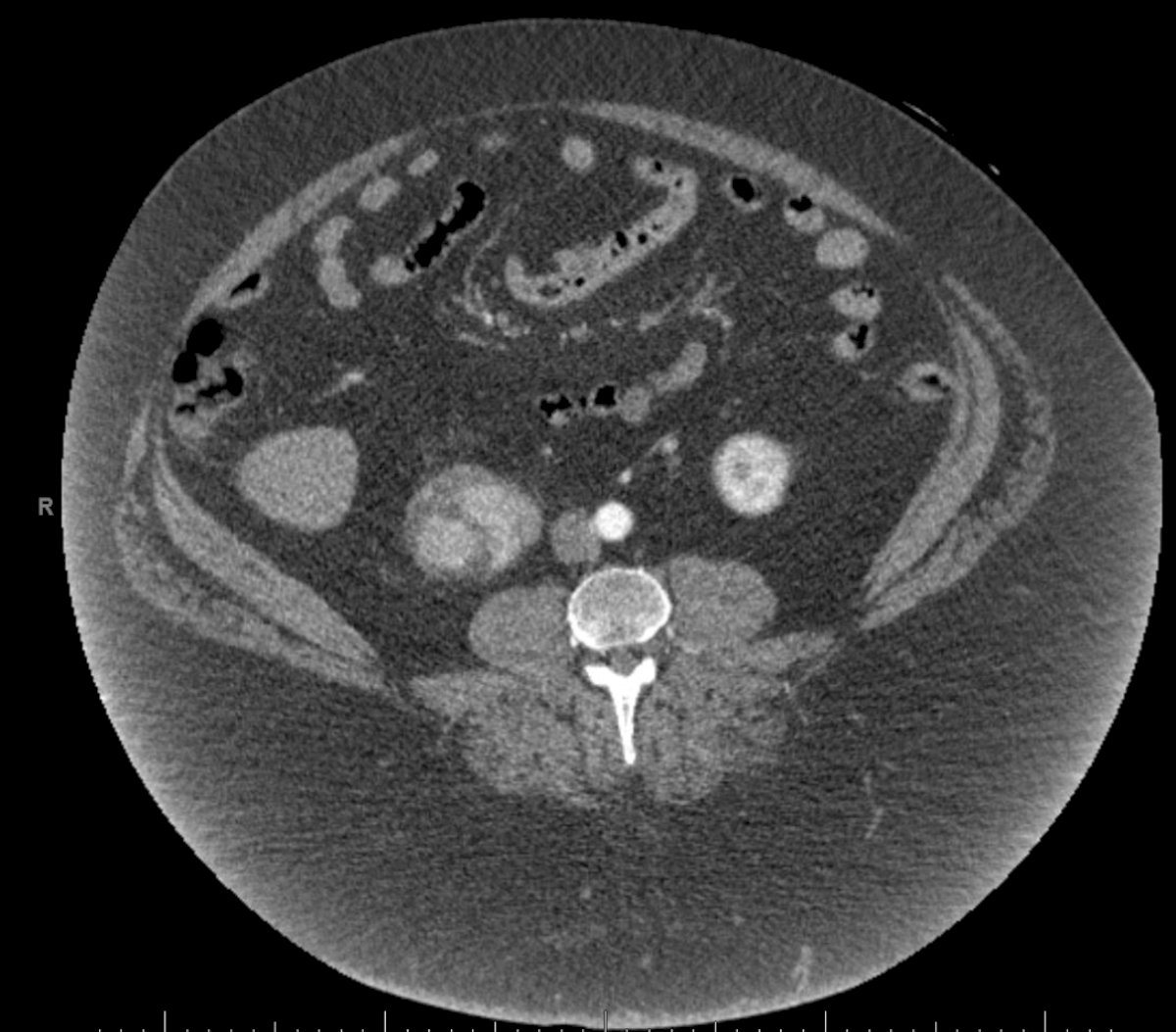 SCS AUA 2025: Techniques for Surgical Treatment of RCC with Morbidly ...