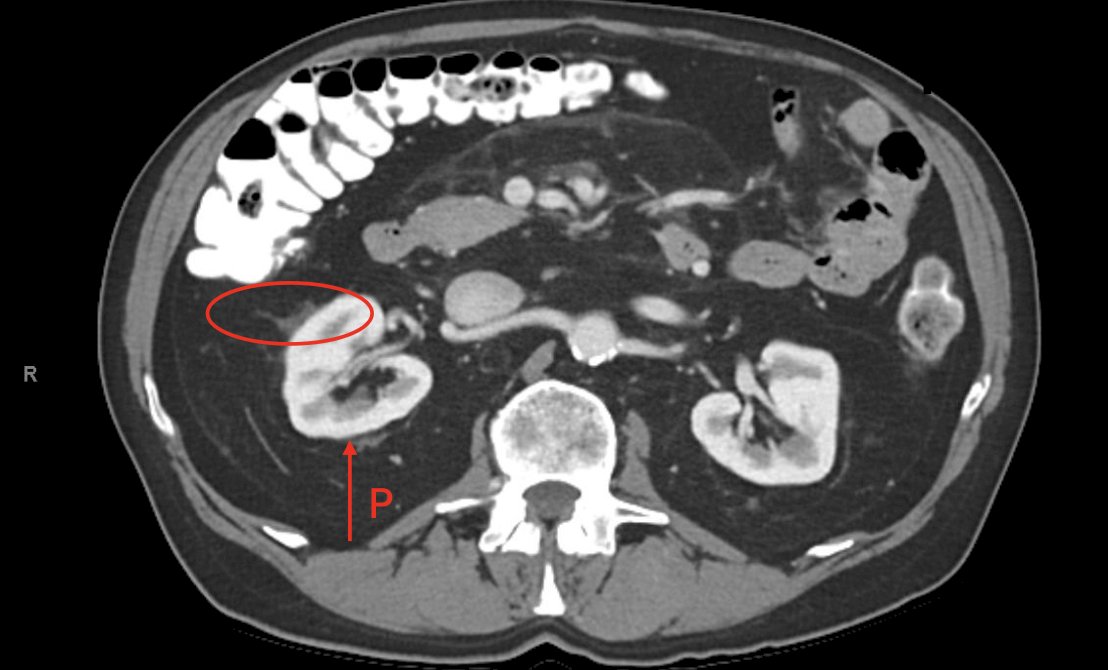 SCS AUA 2025: Techniques for Surgical Treatment of RCC with Morbidly ...